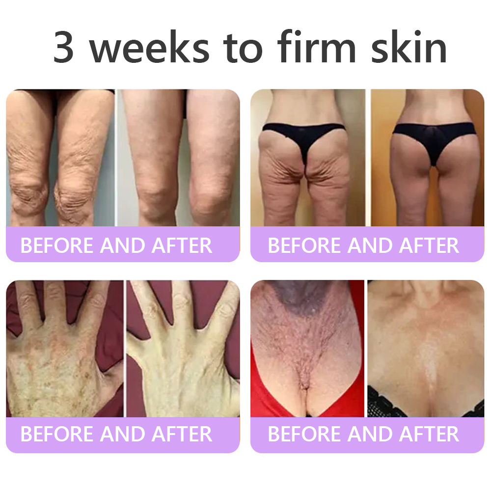 𝑵𝒆𝒚𝒆𝒓𝒐𝒔® PDRN Multi-Peptide Massaging Body Roller Cream- Anti-aging, Hydrating, Skin Firming & Lifting, Skin Repair, Even Tone, Acne and Dark Spot Treatment, Wart and Mole Removal, and Psoriasis Relief