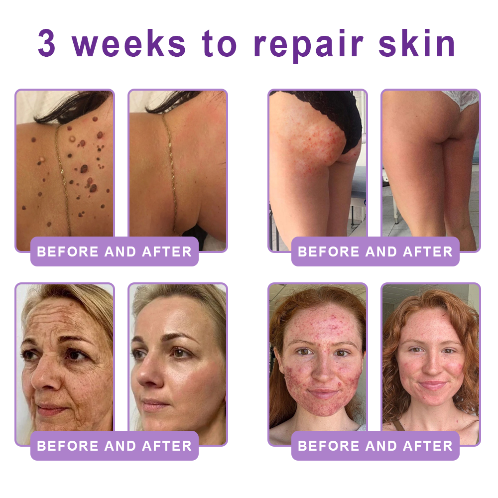 𝑵𝒆𝒚𝒆𝒓𝒐𝒔® PDRN Multi-Peptide Massaging Body Roller Cream- Anti-aging, Hydrating, Skin Firming & Lifting, Skin Repair, Even Tone, Acne and Dark Spot Treatment, Wart and Mole Removal, and Psoriasis Relief