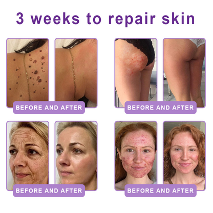 𝑵𝒆𝒚𝒆𝒓𝒐𝒔® PDRN Multi-Peptide Massaging Body Roller Cream- Anti-aging, Hydrating, Skin Firming & Lifting, Skin Repair, Even Tone, Acne and Dark Spot Treatment, Wart and Mole Removal, and Psoriasis Relief