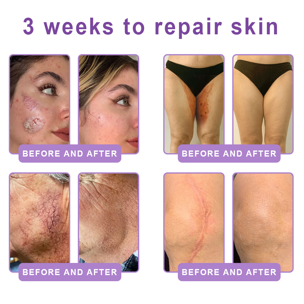 𝑵𝒆𝒚𝒆𝒓𝒐𝒔® PDRN Multi-Peptide Massaging Body Roller Cream- Anti-aging, Hydrating, Skin Firming & Lifting, Skin Repair, Even Tone, Acne and Dark Spot Treatment, Wart and Mole Removal, and Psoriasis Relief
